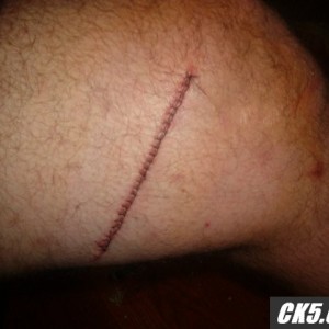 knee