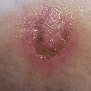 bite update