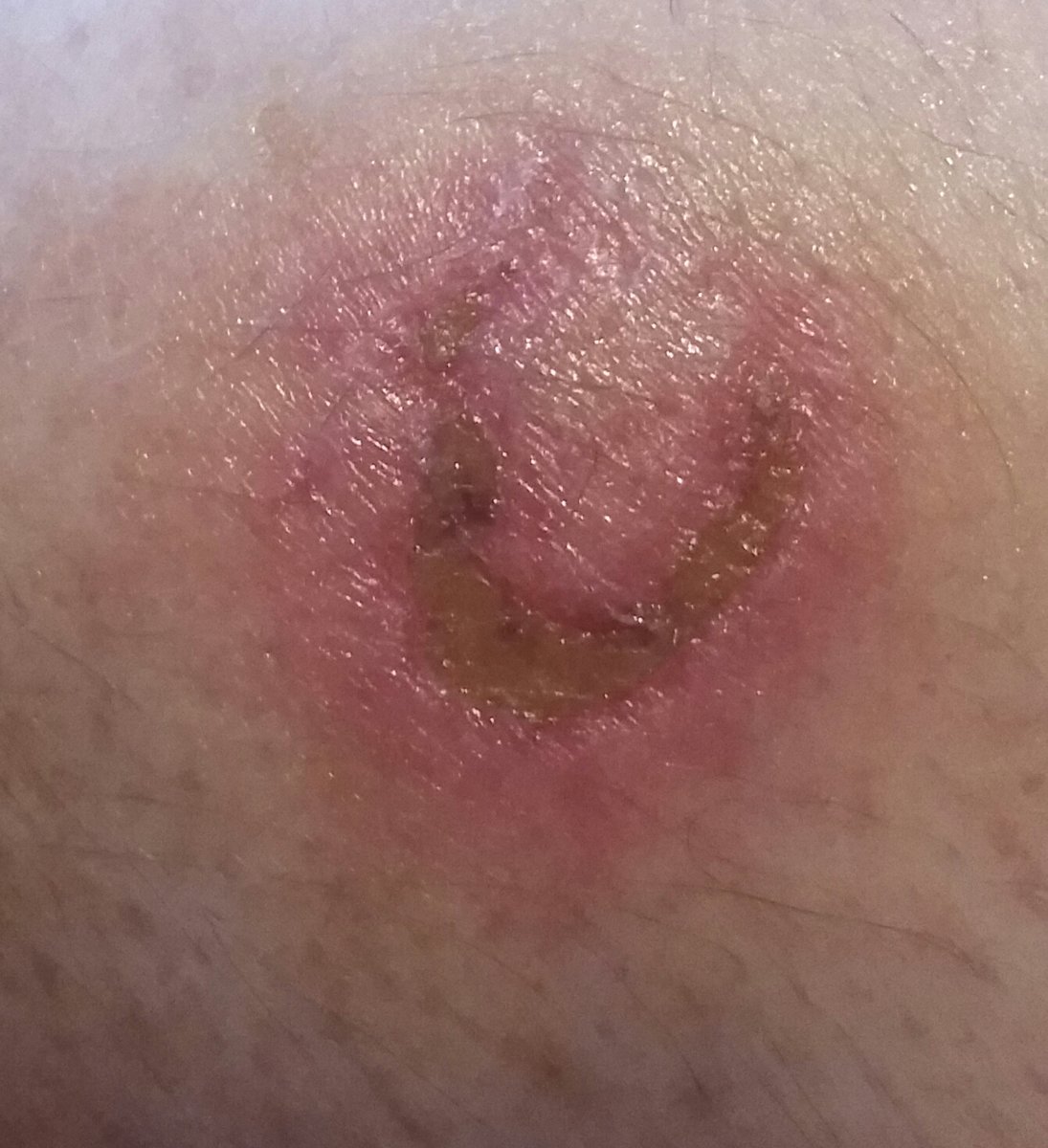 bite update