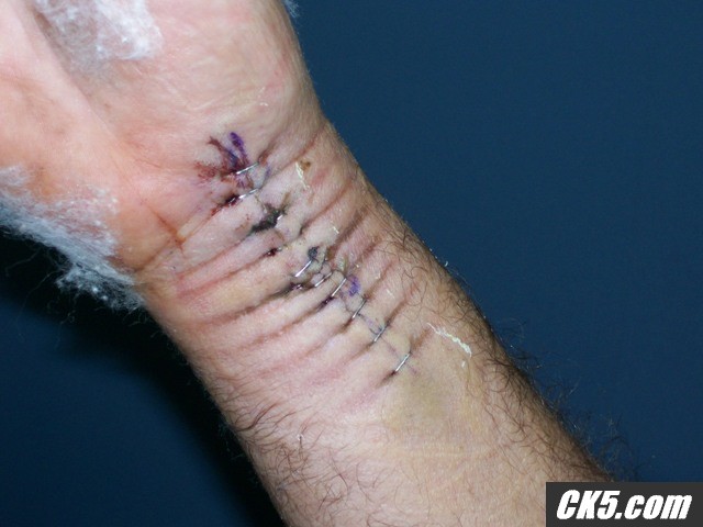 bottom of the wrist