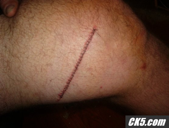 knee